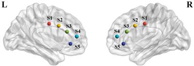 Preliminary findings on the effect of childhood trauma on the functional connectivity of the anterior cingulate cortex subregions in major depressive disorder